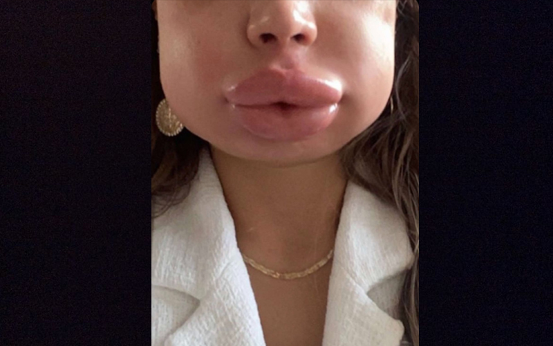 عملية تجميل